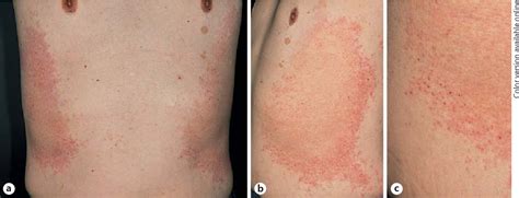 Figure 1 From A New Type Of Annular Erythema With Perieccrine