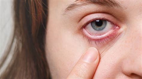 Do Eye Flu Cure With Compresses Best Home Remedies To Cure Eye Flured