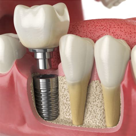 Dental Implants 101 Dr Sam Latif Explains Everything You Need To Know