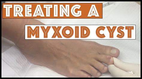 Draining And Treating A Myxoid Cyst Youtube