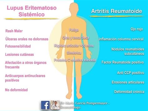 Lupus Eritematoso SistÉmico Les Vs Artritis Reumatoide Ar