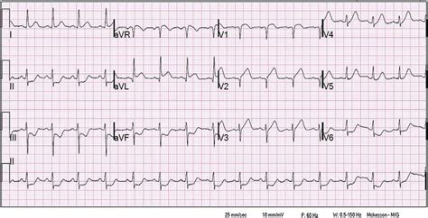 Ekg St Elevation Leads