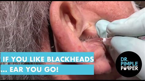 Dr Pimple Popper Blackheads On Ears 2021