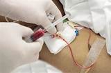 Photos of Arterial Blood Gas Kit