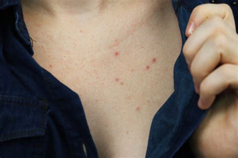 How To Treat Chest Acne According To Dermatologists Popsugar Beauty Uk
