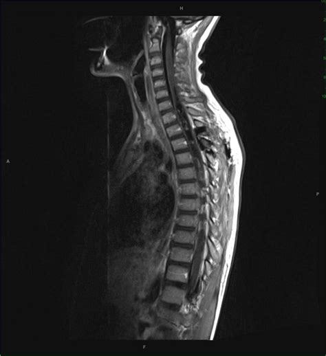 Spinal Cord Ependymoma Neuro Mr Case Studies Ctisus Ct Scanning