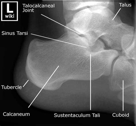 Calcaneus X Ray Anatomy