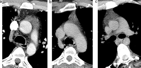 Normal Ct Characteristics Of The Thymus In Adults Semantic Scholar