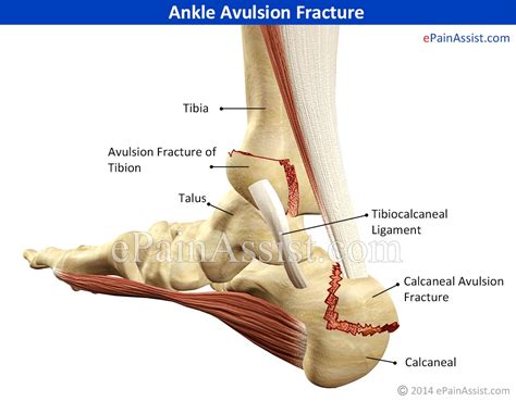 Ankle Avulsion Fracture Symptoms Causes Treatment Recovery Time Exercises