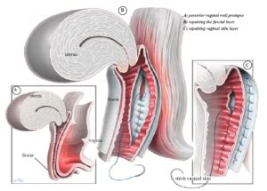 Figure Posterior Vaginal Wall Repair Website Your Pelvic Floor