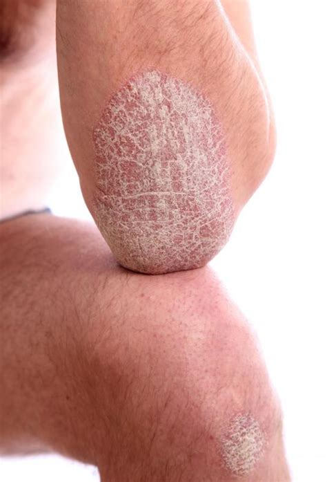 How Do I Treat Dry Skin Patches With Pictures