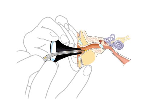 Cerumen And Ear Wax Removal Cleaning And Suction Procedure