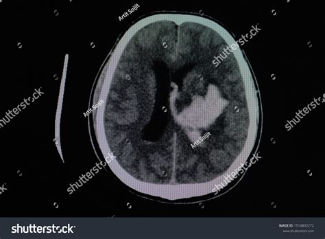 Image Ct Brain Scan Stroke Patient Stock Photo 1514832272 Shutterstock