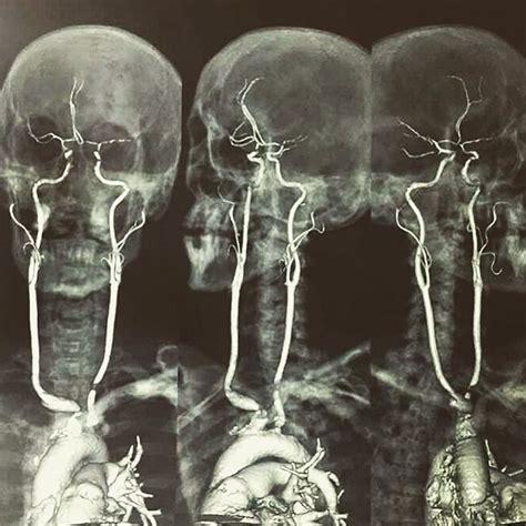 Here Is An Contrasted Mri Showing The Origin And Length Of The Carotid