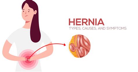 Types Causes And Symptoms Of Hernia