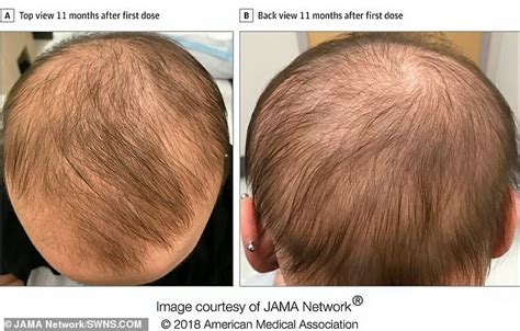 Incredible Transformation Of 13 Year Old Alopecia Patient Daily Mail