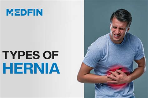 Ppt Types Of Hernia Everything You Need To Know Hernia Surgery In