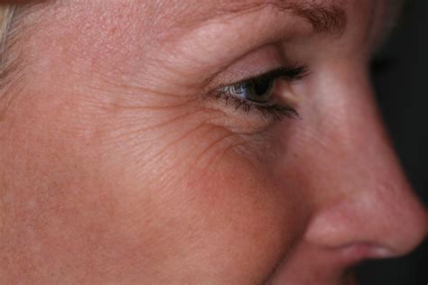 Botox Hertfordshire Eye Treatment Facial Rejuvenation Treatments