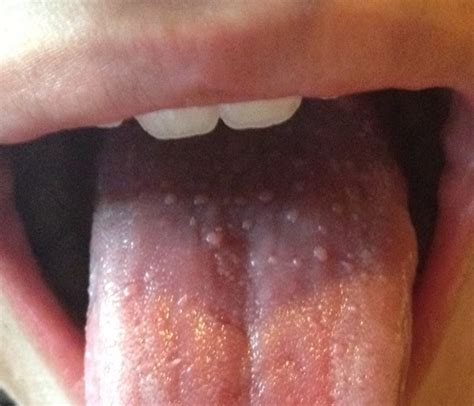 Bumps Near Back Of Tongue Oral Health Community Support Group