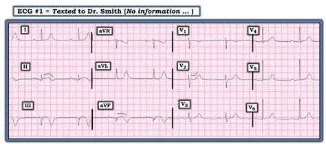 Dr Smiths Ecg Blog Chest Pain And Inferior T Wave Inversion Does