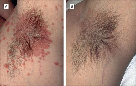 Inverse Psoriasis And Hyperhidrosis Of The Axillae Responding To
