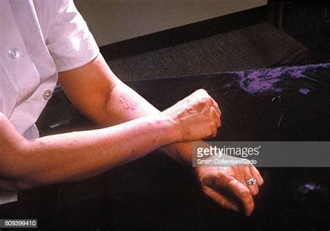 A Patients Arms And Hands Shows The Presence Of Erythema Nodosum