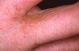 Pictures of Fingernail Eczema Treatment