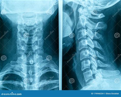 Detail Of Human Neck X Ray Image Stock Photo Image Of Healthcare