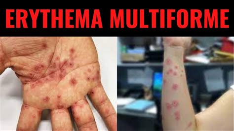 Erythema Multiforme Triggers Symptoms Diagnosis Treatment What