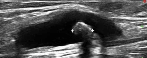 Ultrasound Image Of Bakers Cyst The Cyst Is Oval And Located Deep In