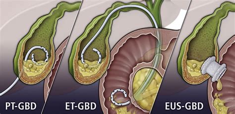 Endoscopic Therapies For Gallbladder Drainage Gastrointestinal Endoscopy