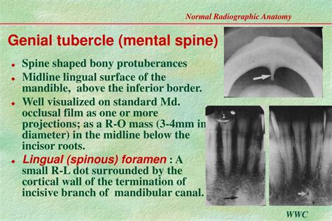 Ppt Normal Radiographic Anatomy Based On Intraoral Films Powerpoint