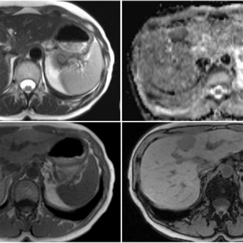 Mri Of The Liver With Hepatobiliary Specific Contrast Agent A Lesion