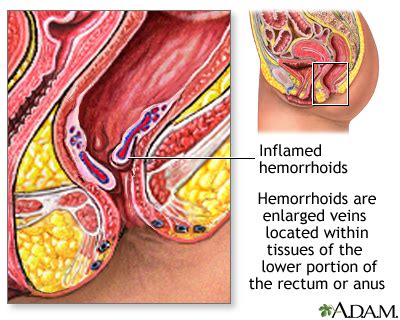 Hemorrhoids Uf Health University Of Florida Health