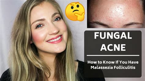 How To Know If You Have Malassezia Folliculitisfungal Acne Tiny