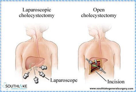 What Are The Benefits Of A Laparoscopic Cholecystectomy Quora