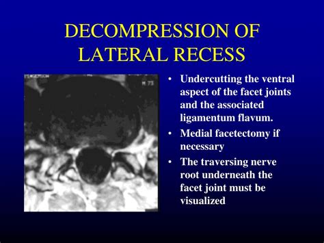 Ppt Spinal Stenosis Powerpoint Presentation Free Download Id456283
