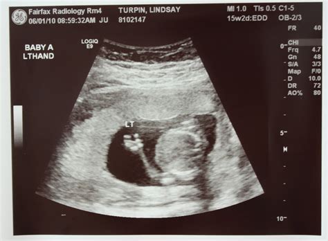 Adventures In Baby Making 16 Weeks Ultrasound Pics