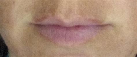 What Causes Black Patches On Lips