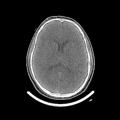 Skullfracture Skull Head And Neck Cts