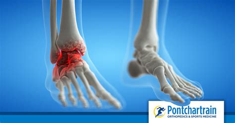 Broken Or Sprained Ankle Pontchartrain Orthopedics And Sports Med