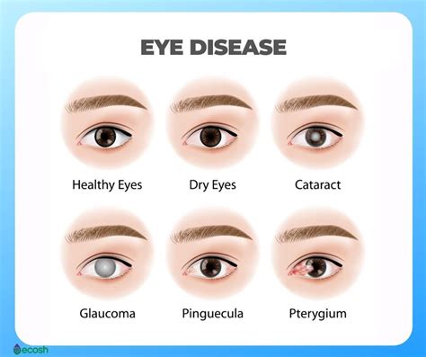 Eye Vitamins And Eye Health Vitamins And Foods That May Strengthen