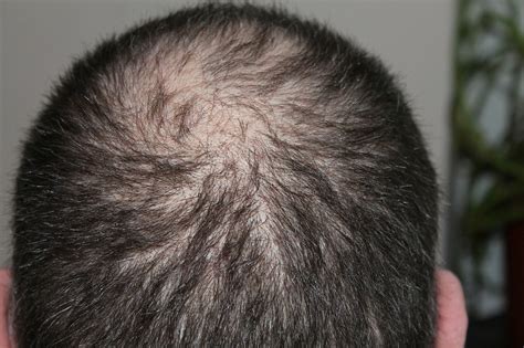 5 Early Signs Of Hair Loss Melbourne Hairlogica