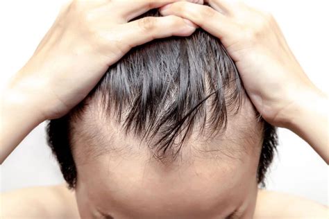 Male Pattern Baldness Why And How It Occurs The Washington Note
