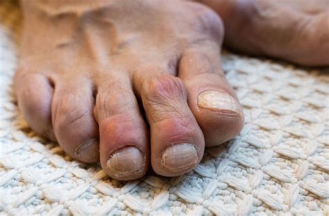 What Causes High Uric Acid Levels That Can Lead To Gout Cleveland Clinic