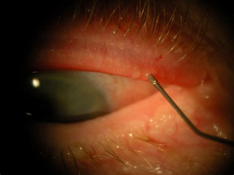 Maskin Meibomian Gland Probing For Physicians — Mgdinnovations