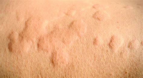 Causes Of Heat Rash Heat Hives Symptoms Treatment And Prevention