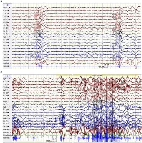 Frontiers Case Report Distinctive Eeg Patterns In Scarb 2 Related