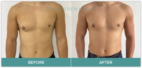 Gynecomastia Treatment Experts In Sydney Crown Clinic