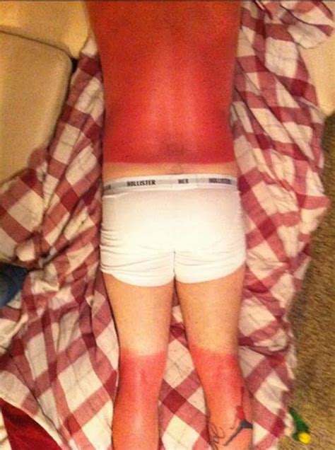 Worst And Funniest Sunburn Ever Mirror Online